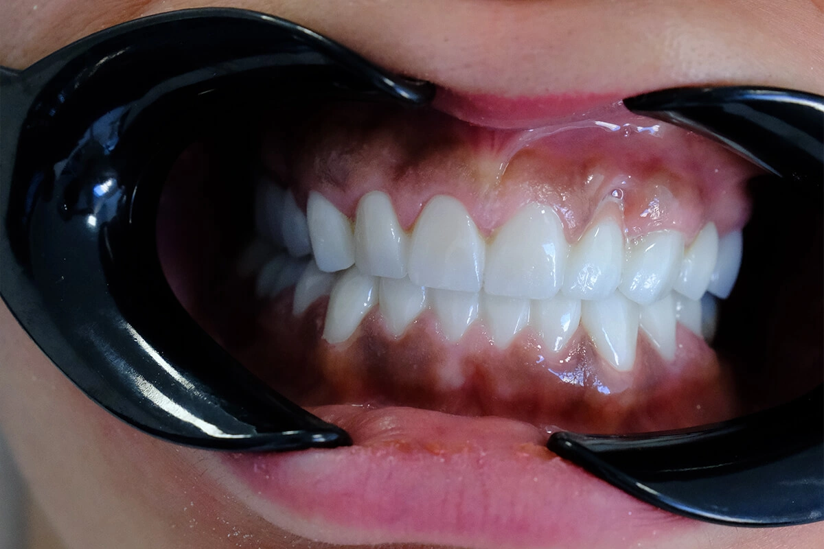 Ästhetisches Lächeln-Design