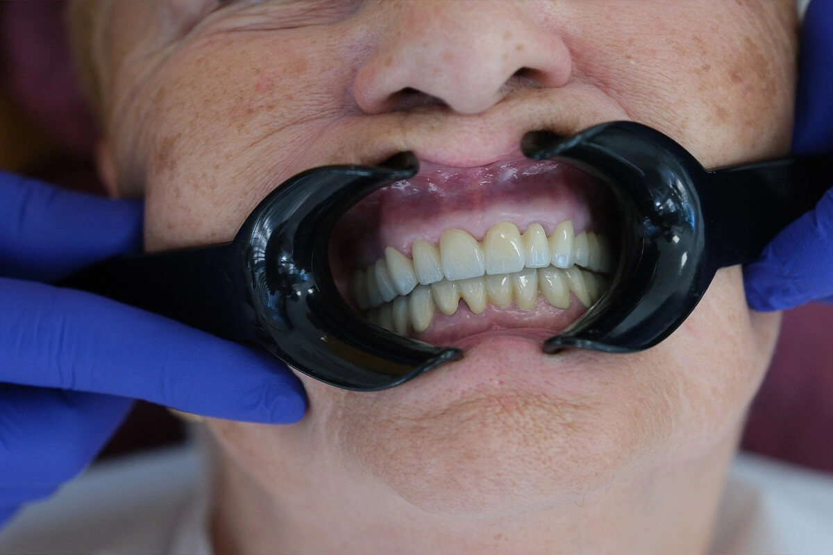 Zahnaufhellungsergebnis