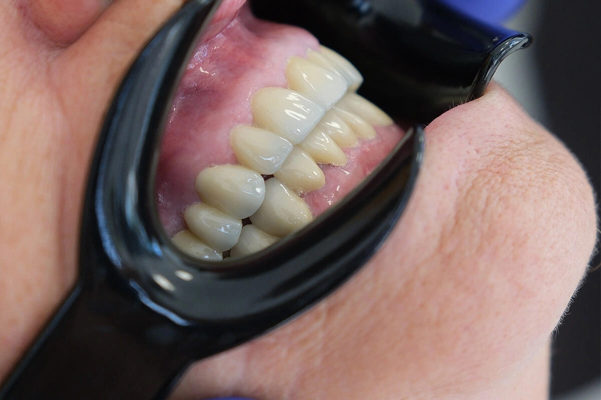 Vollständige Mundrestauration