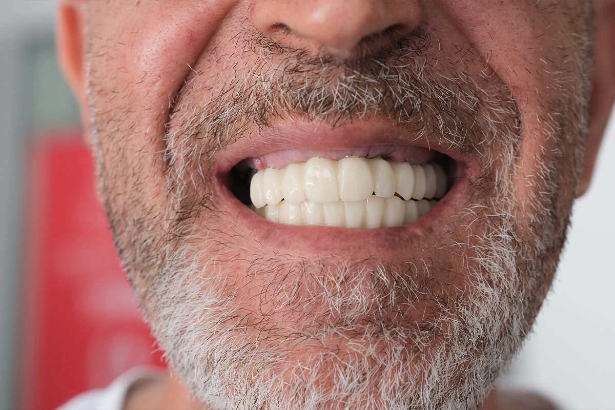 Ästhetische Füllung & Lächeln