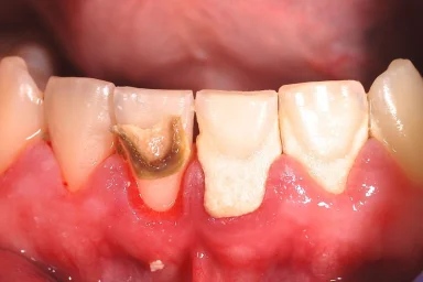  What Should You Do to Prevent Tartar Formation?