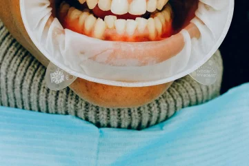 Dental Gum Diseases: Treatment Methods and Recommendations
