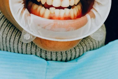 Maladies des Gencives Méthodes de Traitement et Recommandations