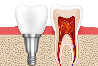 Dental Implant Treatment for Healthy Smiles in Alanya