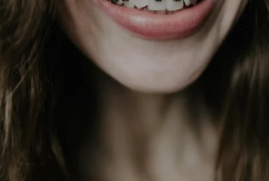 Expert Orthodontic Treatment for Beautiful Smiles at Alanya Dental Clinic
