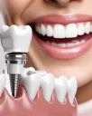 Dental Implants in Alanya Expert Treatment and Modern Implant Technologies | 2025 Guide
