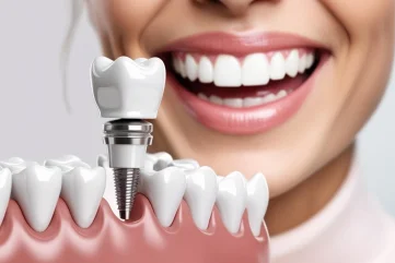 Zahnimplantat-Spezialbehandlung und moderne Implantat-Technologien in Alanya | 2025 Leitfaden - Moon Dental Alanya Blog