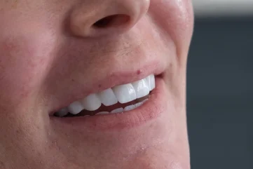 Lassen Sie Ihr Lächeln neu gestalten: Zahnästhetik in Alanya - Moon Dental Alanya Blog