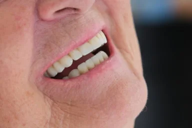  Alanya Dental Clinics Aesthetic Filling Applications (Composite Bonding)