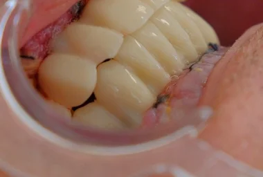 What Is the Best Age to Get Braces in Alanya? – Comprehensive Orthodontic Age Guide