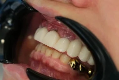 Différences entre implants et couronnes à Alanya : quel traitement est fait pour vous