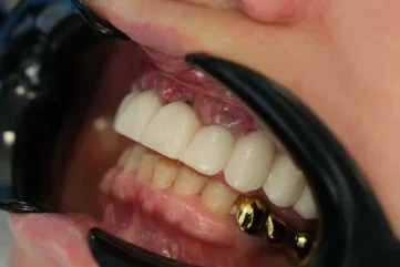 Differences Between Implants and Crowns in Alanya: Which Treatment Is Right for You? - Moon Dental Alanya Blog