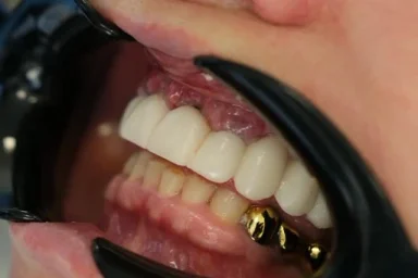  Differences Between Implants and Crowns in Alanya: Which Treatment Is Right for You?
