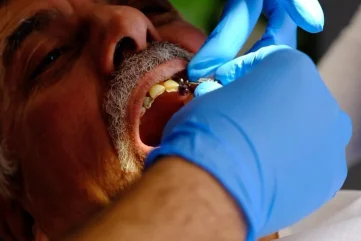 Causes and Treatment of Gum Bleeding in Alanya: Comprehensive Guide - Moon Dental Alanya Blog