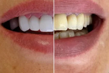 Daily Dental Care Routines in Alanya - Moon Dental Alanya Blog