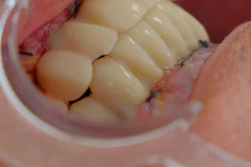 Guide spécial des soins dentaires pour les fumeurs à Alanya : Tabac et santé bucco-dentaire - Moon Dental Alanya Blog