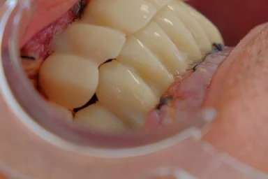  Special Dental Care Guide for Smokers in Alanya: Smoking and Oral Health