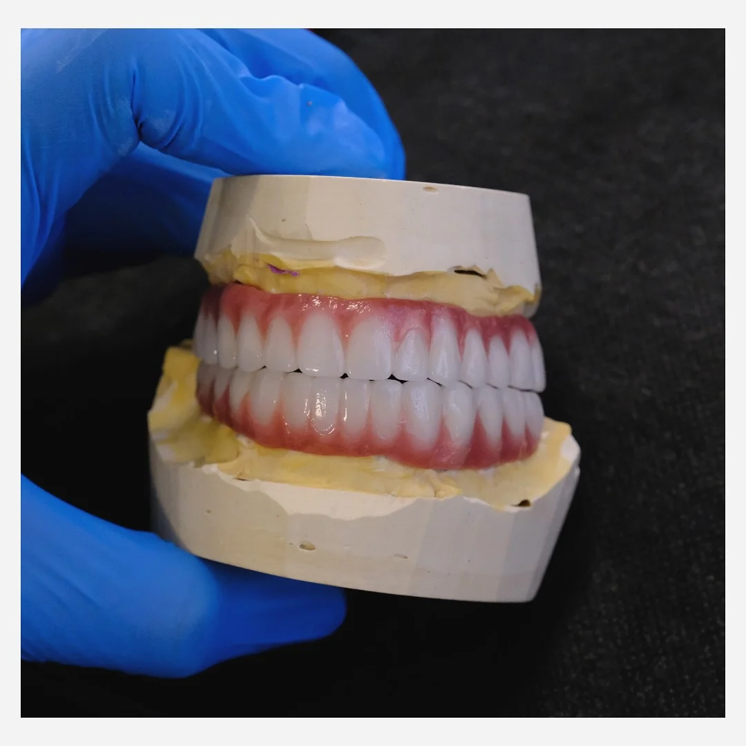 Ein Hollywood-Lächeln mit Vollkeramik-Veneers in Alanya erzielen