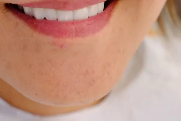 Farbangleichung bei Zahnprothesen in Alanya - Moon Dental Alanya Blog