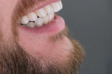 Nouvelle ère de l’esthétique dentaire : transformation du sourire en 7 jours avec des facettes - Moon Dental Alanya Blog